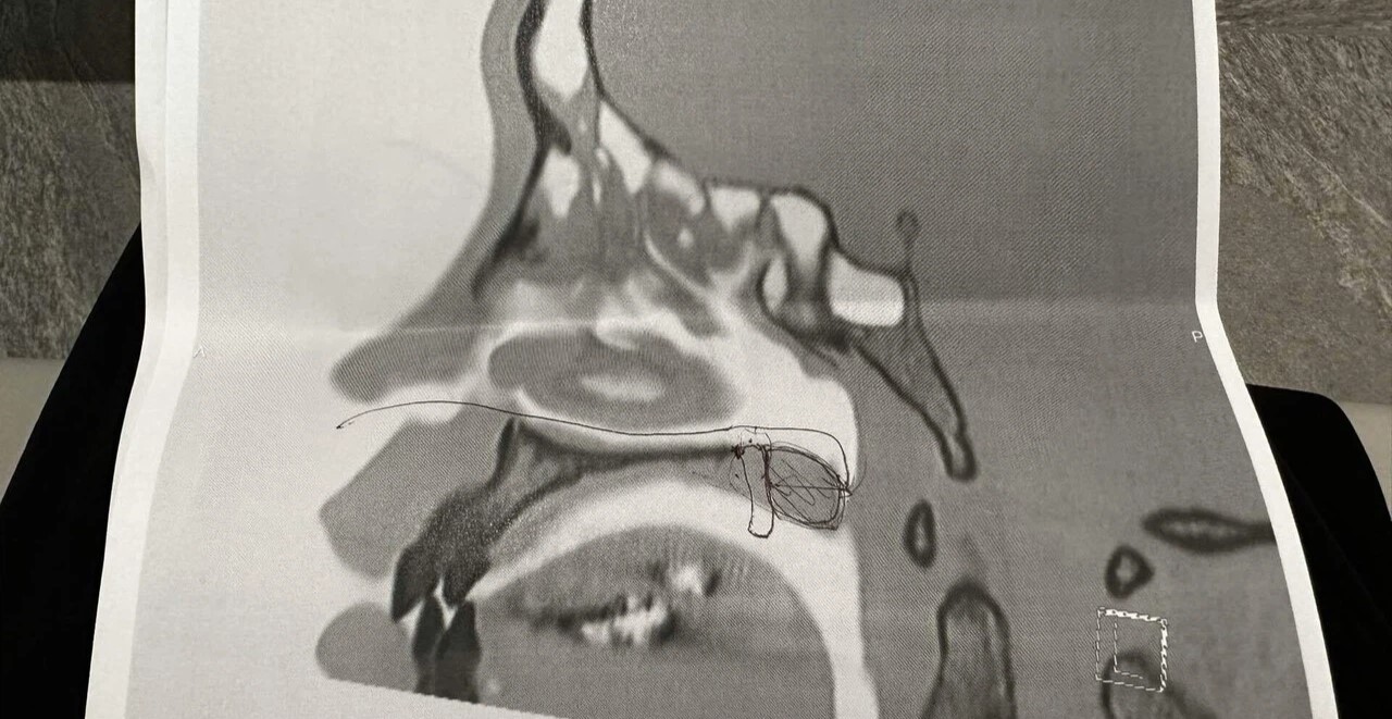 My Nose Disease, All in One Go